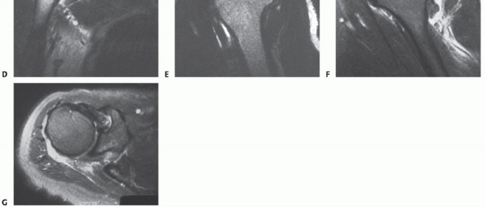 Illustration 3 for Subscapularis & Teres Rotator Cuff Repair: Advanced Techniques