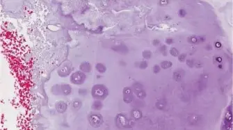 صورة توضيحية لـ الأورام الغضروفية في عظم العضد القريب دليل شامل للمرضى والعلاج في صنعاء