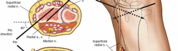 Illustration 15 for Key Approaches for External Fixation: Humerus, Radius, Ulna, Wrist