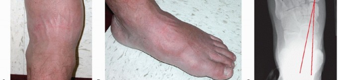 Illustration 6 for Regain Mobility: Surgical Solutions for Charcot Foot Arthropathy