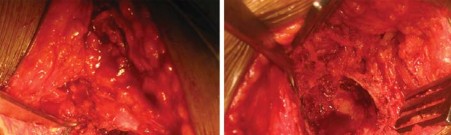 Illustration 36 for Total Hip Arthroplasty: Restoring Mobility in Juvenile Idiopathic Arthritis