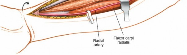 Illustration 19 for Radius Anterior Approach: Safe Nerve Protection & Complete Exposure