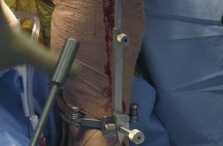 Illustration 19 for Posterior Stabilized Technique: Essential Insights for TKA Success