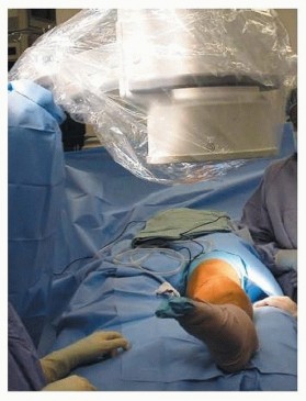 Illustration 5 for Optimal Treatment for Pediatric Tibial Fractures: Key Insights