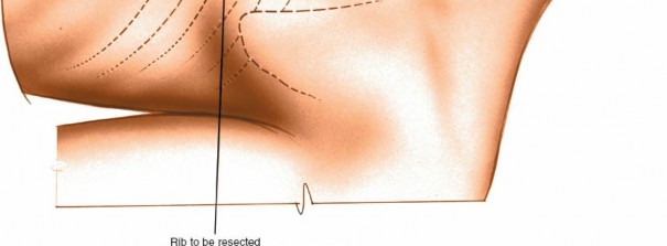 Illustration 291 for Approach to the Lumbar Spine: Mastering Techniques & Anatomy