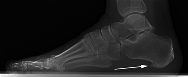 Illustration 34 for First Metatarsal Surgery: Expert Solutions for Foot & Ankle Pain