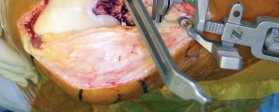 صورة طبية: استبدال مفصل الركبة بالحد الأدنى من التدخل الجراحي: ألم أقل وتعافٍ أسرع مع النهج شبه الرضفي الإنسي