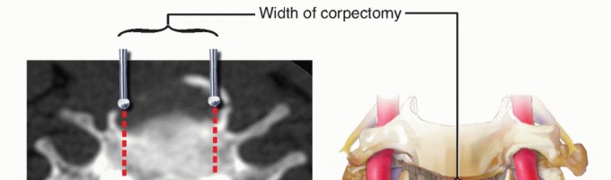 Illustration 6 for Stop Numbness & Instability: Corpectomy and Fusion Guide