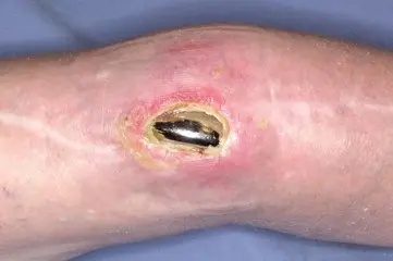 صورة توضيحية لـ مباعد PROSTALAC المفصلي: حل مبتكر لعلاج التهاب الركبة واستعادة حركتها مع الأستاذ الدكتور محمد هطيف