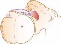Illustration 3 for Arthroscopic Subscapularis Repair: The lo iky brady Method for Stability