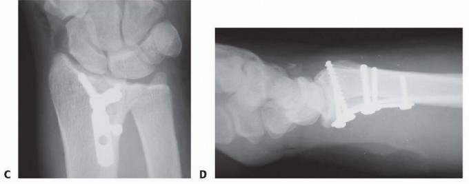 Illustration 25 for Fragment-Specific Fixation: Restore Carpal Facet Horizon