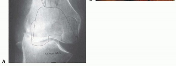 Illustration 6 for Femoral Bone Loss: Metal Augments for Revision Knee Success