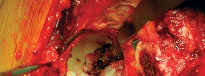 Illustration 27 for Cemented Component Longevity: The Critical Margin of the Acetabulum