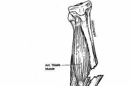 Illustration of tibia and fibula - Dr. Mohammed Hutaif