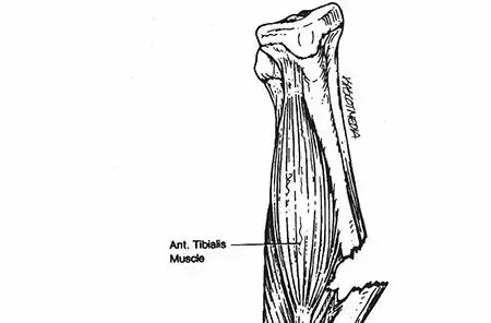 كسور عظم الساق (القصبة والشظية) لدى الأطفال: دليل شامل للآباء من الأستاذ الدكتور محمد هطيف