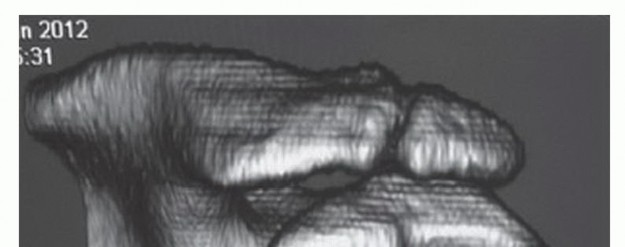 Illustration 3 for Find Relief: Arthroscopic Subacromial Decompression for Impingement