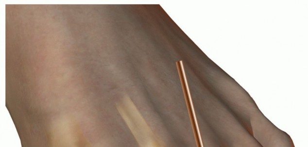 Illustration 27 for Hammer Toe Correction: Understanding the Extensor Digitorum Longus