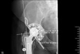 Illustration 5 for Solving Severe Acetabular Bone Loss with Cup-Cage Reconstruction