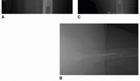 Illustration 24 for Extended Trochanteric Osteotomy: How et al Extended Revision THA Solutions