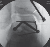 Illustration 27 for Talar Neck Fracture Treatment: Optimizing Recovery with ORIF