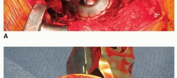 Illustration 8 for Uncemented Acetabular Revision: Optimizing Hemispherical Cup Use