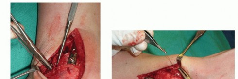 Illustration 32 for Painful Talus Lesions? The tech fig c Osteochondral Transfer Solution