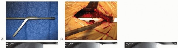 Illustration 15 for ORIF for Peritrochanteric Hip Fractures: Achieve Stable Mobility