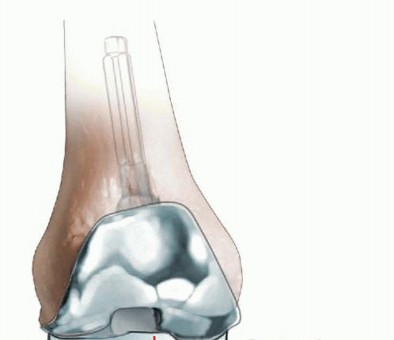 Illustration 20 for Correcting Stiffness in Revision TKA: Achieve Appropriate External Rotation