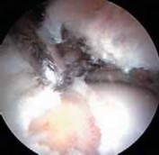 Illustration 30 for Resolving Femoral Head Neck Impingement: Arthroscopic FAI Solutions