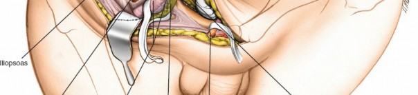 Illustration 28 for Ilioinguinal Approach: Master the Deep Inguinal Ring for Success