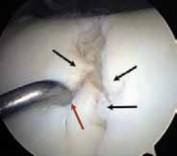 Illustration 9 for Microfracture Chondroplasty: How Tiny Holes Are Made to Fix Cartilage