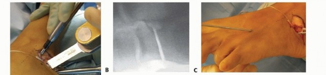 Illustration 13 for Calcaneal Lengthening Osteotomy: Correcting Hindfoot Valgus