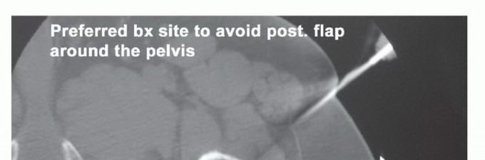 Illustration 8 for Posterior Flap Hemipelvectomy: Mastering Techniques for Optimal Outcomes