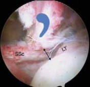 Illustration 22 for Arthroscopic Subscapularis Repair: The lo iky brady Method for Stability
