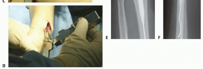 Illustration 22 for Distal Radius Fixation: Precision Through Lister's Tubercle