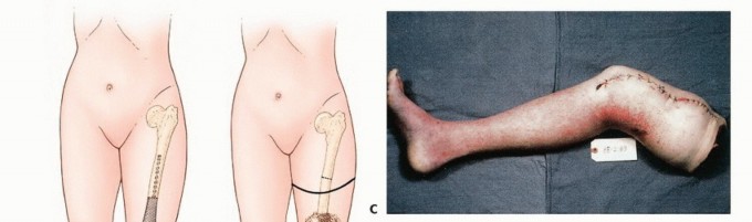 Illustration of aboveknee amputation aboveknee - Dr. Mohammed Hutaif