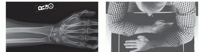 Illustration 19 for Radial Head & Neck Fractures: Mastering ORIF for Best Results