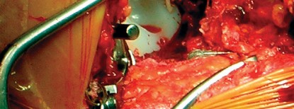 Illustration 70 for Cemented Component Longevity: The Critical Margin of the Acetabulum