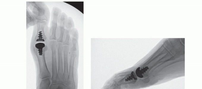 Illustration 57 for End Articular Cartilage Loss: Arthrosurface HemiCAP Resurfacing
