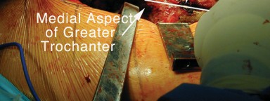 Illustration 15 for Achieving Success with Trochanteric Osteotomy Posterior for Revision