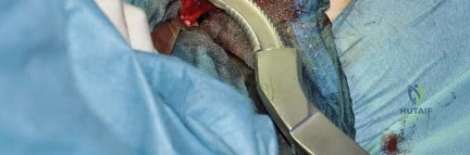 صورة طبية: استبدال مفصل الورك بتقنية الحفاظ على عنق الفخذ (CFP): نتائج أولية أفضل ورعاية متقدمة في صنعاء مع الأستاذ الدكتور محمد هطيف