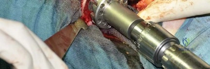صورة طبية: استبدال مفصل الورك بتقنية الحفاظ على عنق الفخذ (CFP): نتائج أولية أفضل ورعاية متقدمة في صنعاء مع الأستاذ الدكتور محمد هطيف
