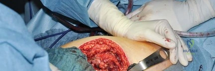 صورة طبية: استبدال مفصل الورك بتقنية الحفاظ على عنق الفخذ (CFP): نتائج أولية أفضل ورعاية متقدمة في صنعاء مع الأستاذ الدكتور محمد هطيف