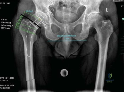 صورة طبية: استبدال مفصل الورك بتقنية الحفاظ على عنق الفخذ (CFP): نتائج أولية أفضل ورعاية متقدمة في صنعاء مع الأستاذ الدكتور محمد هطيف