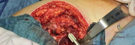 صورة طبية: استبدال مفصل الورك بتقنية الحفاظ على عنق الفخذ (CFP): نتائج أولية أفضل ورعاية متقدمة في صنعاء مع الأستاذ الدكتور محمد هطيف