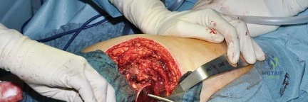 صورة طبية: استبدال مفصل الورك بتقنية الحفاظ على عنق الفخذ (CFP): نتائج أولية أفضل ورعاية متقدمة في صنعاء مع الأستاذ الدكتور محمد هطيف