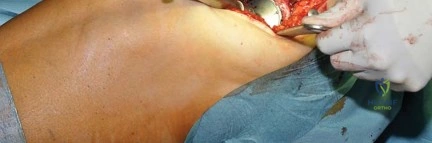 صورة طبية: استبدال مفصل الورك بتقنية الحفاظ على عنق الفخذ (CFP): نتائج أولية أفضل ورعاية متقدمة في صنعاء مع الأستاذ الدكتور محمد هطيف