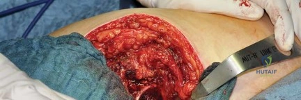 صورة طبية: استبدال مفصل الورك بتقنية الحفاظ على عنق الفخذ (CFP): نتائج أولية أفضل ورعاية متقدمة في صنعاء مع الأستاذ الدكتور محمد هطيف