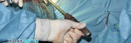 صورة طبية: استبدال مفصل الورك بتقنية الحفاظ على عنق الفخذ (CFP): نتائج أولية أفضل ورعاية متقدمة في صنعاء مع الأستاذ الدكتور محمد هطيف