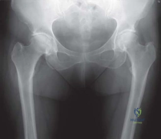صورة طبية: استبدال مفصل الورك بتقنية الحفاظ على عنق الفخذ (CFP): نتائج أولية أفضل ورعاية متقدمة في صنعاء مع الأستاذ الدكتور محمد هطيف